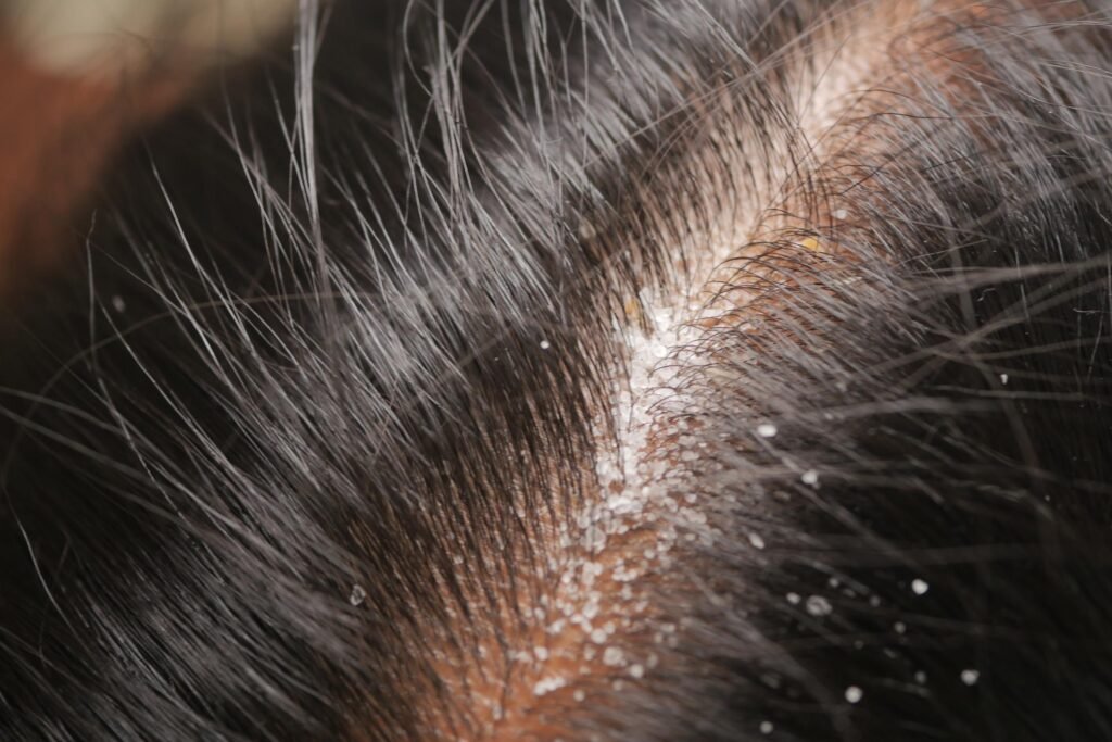 home remedies for dandruff
